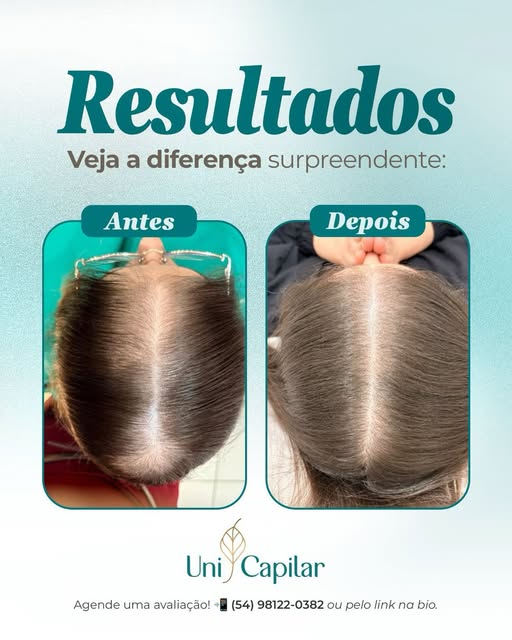 ✨ Resultado que vai além da estética!

Essa paciente passou por um período de estresse intenso, perd