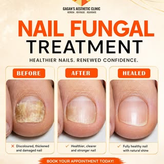Healthy nails, renewed confidence! ✨
Get professional Nail Fungal Treatment at Gagan’s Aesthetic Cli