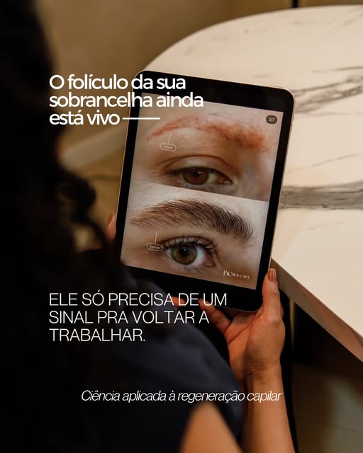 Sobrancelha falhada ou rala? 

Conheça os exossomos: tecnologia regenerativa que ativa o folículo ca