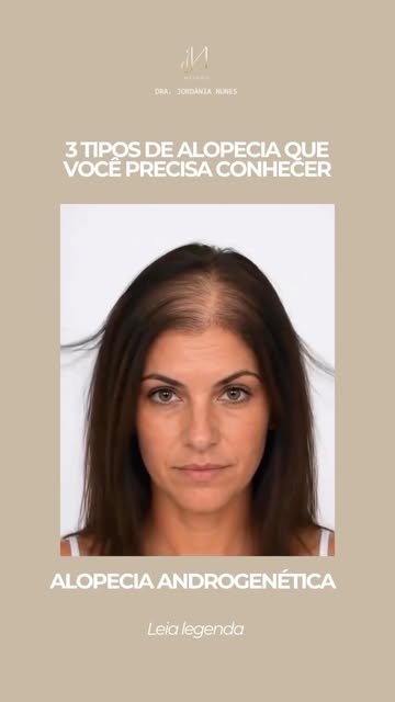 Alopecia não é uma condição única — e entender essa diferença importa.

Alopecia androgenética, alop