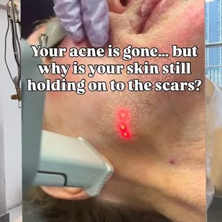 Your acne may be gone… but the scars stay because they sit deep inside your skin layers.

✨ CO2 Frac
