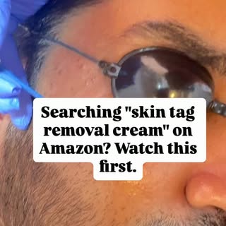 Why do you get skin tags?
1. Friction - From tight clothes, collars & jewellery
2. Weight Gain - Mor