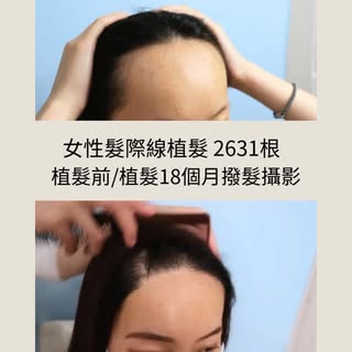 女生髮際線植髮變化記錄 2631根

客人的頭髮整體是很多的，但額頭高一直困擾著客人。髮際線的位置與形狀，大大影響臉型比例與自信。
📸 影片中可見：
✨ 撥髮近距離特寫，呈現髮際線細節
✨ 術前 v