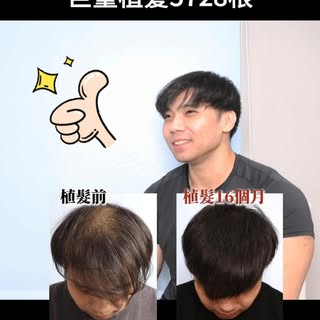 頭頂至前額加密巨量植髮5728根
 
因為本身是健身教練，需要跟人接觸，所以選擇來到秀冠植髮。
訪問是植髮後16個月回診，無準備且真實的訪問，訪問還有搭配撥髮影片及照片。
 
建議搭配上一篇的案例Re