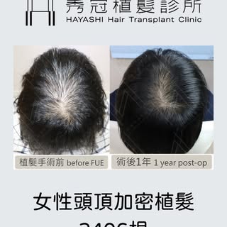 女性頭頂加密植髮 2406根

頭頂加密植髮，需要仔細的挑選種植毛囊位置，避開間距過小的地方，我們希望原有的毛囊還是可以繼續生長，每個毛囊都很寶貝。
這個案例俯視的拍照，我們照了兩種不同髮流。同時還有