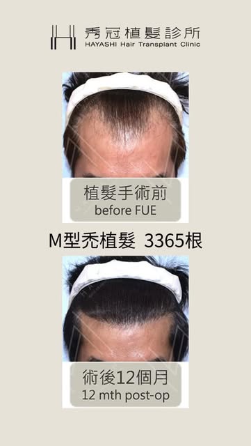 ✨M型禿植髮 3365根

客人的髮質整體偏細，對於M型禿帶來的困擾很在意。
來秀冠規劃植髮，除了希望填補M型禿，同時也稍微下降一點髮際線。
這個案例我們放了各式角度，可以清楚的看到植髮後的改變喔!
