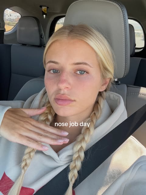 Swipe to see the process of a bump shave rhinoplasty two weeks out. We are revisiting this case beca