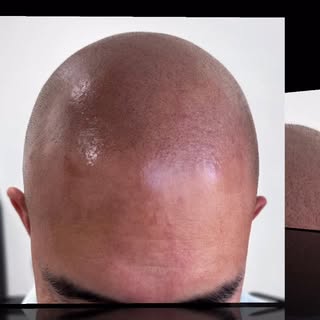 Been thinking about #smp but apprehensive about all the botched results? I have seen quite a few lat