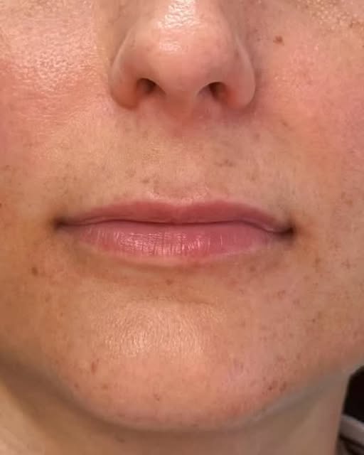 This beautiful client wanted natural result with better volume and shape symmetry. 
-subtle outline 