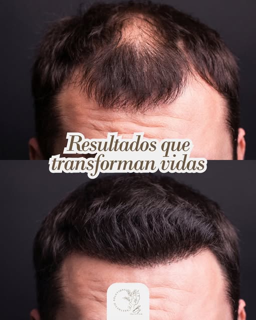 Dale una nueva oportunidad a tu cabello #injertocapilar #cdmx #méxico