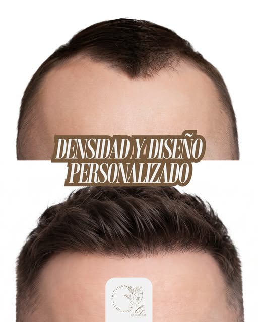 La línea frontal de tu cabello hace que se enmarque mejor tu rostro! #aestheticsolutions #injertocap
