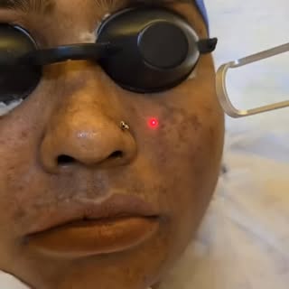 ✨Glow in progress! Witness the magic of Laser Toning — brighter, smoother, more radiant skin in minu