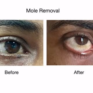 ✅ Bid a goodbye to unwanted moles—welcome smooth, confident skin! ⭐️
✅ Have quick, precise & scar-mi