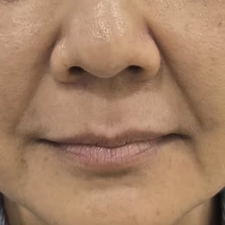 Dry, cracked lips? 👄 😔
✨ Give them the hydration they deserve with a Skin Booster for Lips—for sof