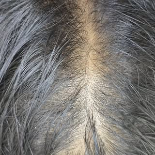 ✨ Stronger roots. Thicker hair. Greater confidence. 💉🧬

Hair Exosome Therapy is the next generatio