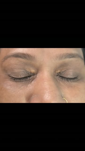 ✨ Xanthelasma? Don’t just cover it—treat it! 👀

✅️ From diagnosis to the right procedure, personali