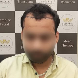 These before & after images showcase actual patient results following hair transplant procedures at 