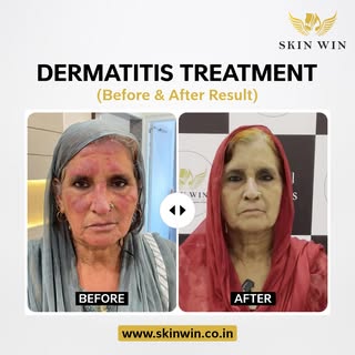 ✨ Dermatitis Treatment – Visible Results!
.
Struggling with redness, itching, or irritated skin?
Wit