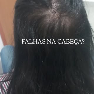 Queda capilar não se trata apenas de esconder os fios que caem. É preciso tratar a causa e estimular