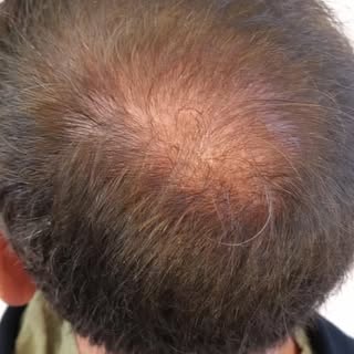 3éme/4– Effet densité 💥
Mon client avait déjà réalisé 2 greffes capillaires.
Aujourd’hui, une 3ème 
