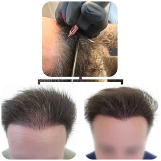 Ta ligne frontale manque de densité ?

La micropigmentation capillaire effet densité recrée un effet