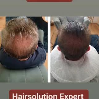 ✅ Résultat après la 2ᵉ session de micropigmentation capillaire effet densité.
Cette séance permet de