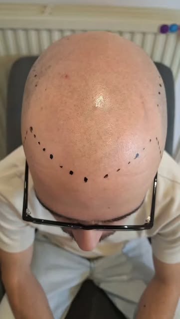 À seulement 18 ans, mon client souffrait déjà d’une calvitie précoce. Il a commencé à perdre ses che