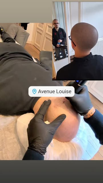 🔥🔥🔥
#MicropigmentationCapillaire #EffetRasé #ScalpMicropigmentation #SMP #Tricopigmentation Densi