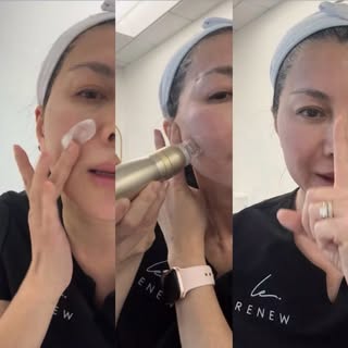 Sylfirm X Microneedling

Numbing first… then it’s time to treat!

Today I’m doing Sylfirm X micronee
