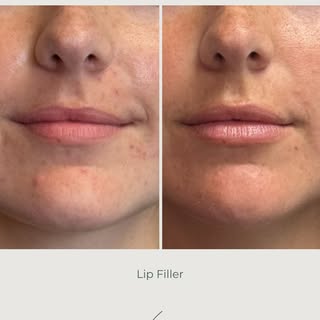 💋 A subtle enhancement can make a beautiful difference.

Her lips are now smoother, more balanced, 