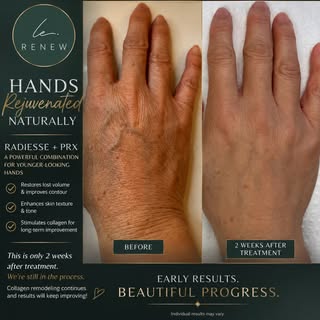 Hands are often one of the first places to reveal signs of aging.

This before & after shows 2 weeks
