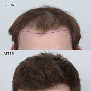 22 years old and dialed in.

2,700 grafts with the Advanced FUE looks so good.

Click the link in ou