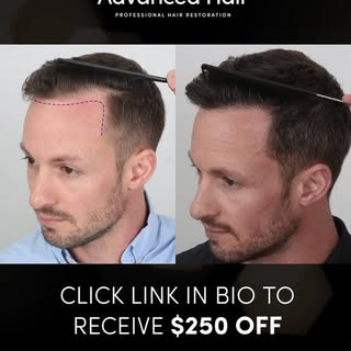 The all natural hairline.

2,700 grafts with our Simple 1 Day Treatment!

Click the link in our bio 