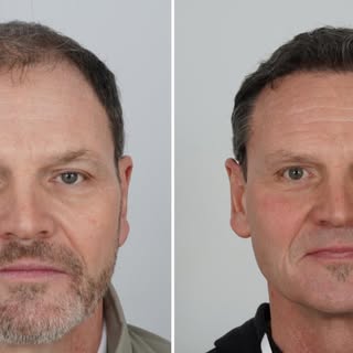 Age Rewind: How a Hair Transplant Transformed His Look. 

Our patient is 57 years old and 13 months 