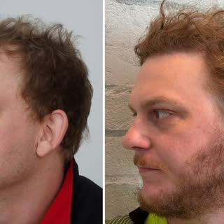 Hair That Looks Good from Every Angle.

This patient is 33 years old and one year out from his Advan