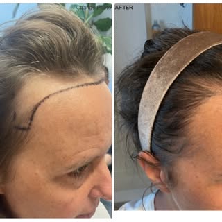 Here we have a 48 year old female who never liked the deep corners of her hairline. This made her un