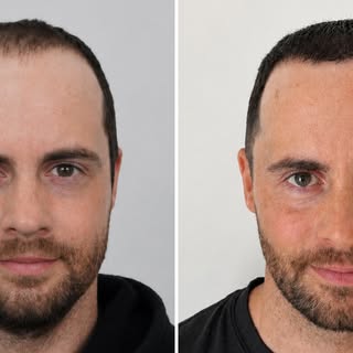 He didn’t just get his hair back—he got his confidence back.

Here we have a 37 year old male who is