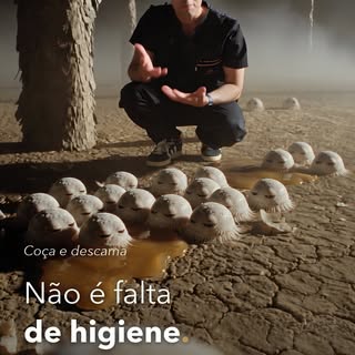 Coça, descama, e a pessoa acha que é falta de higiene.

Não é.

A dermatite seborreica do couro cabe