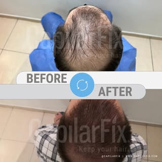 📸 Antes y después de confiar en CapilarFix.

✨ Con nuestro enfoque multidisciplinario, tratamos cad