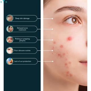 🚨SERIES: Acne & Acne marks - all you need to Know about acne. Acne may go, but the marks stay??!! D