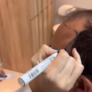 Um ano depois, o resultado fala por si. ✨

Em julho do ano passado, esse paciente veio de fora do Br