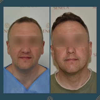 👉 "Why did I wait so long to get a hair transplant?"

A phrase we hear very often from our patients