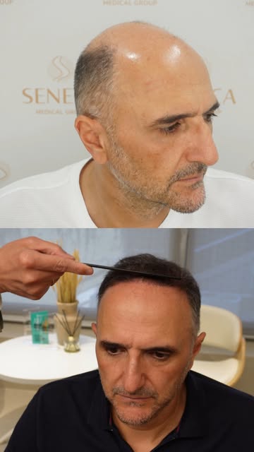 No filters needed when the results look this natural. 😉
Every hair restoration is carefully designe