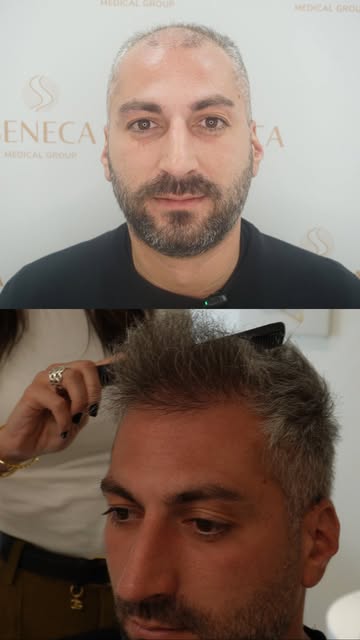 🪮😏 Designed to look natural from every angle.
Exactly as it should👌

📱 Considering a hair transp