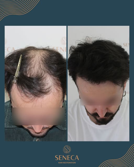 Hard to believe it's the same person.👀

📱 Considering a hair transplant? Our medical team is here 