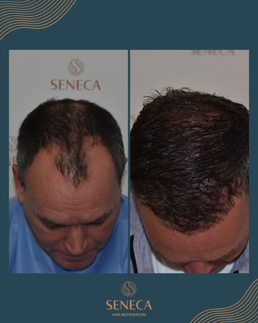 365 days later. 🔄

📱 Considering a hair transplant? Our medical team is here to guide you through 