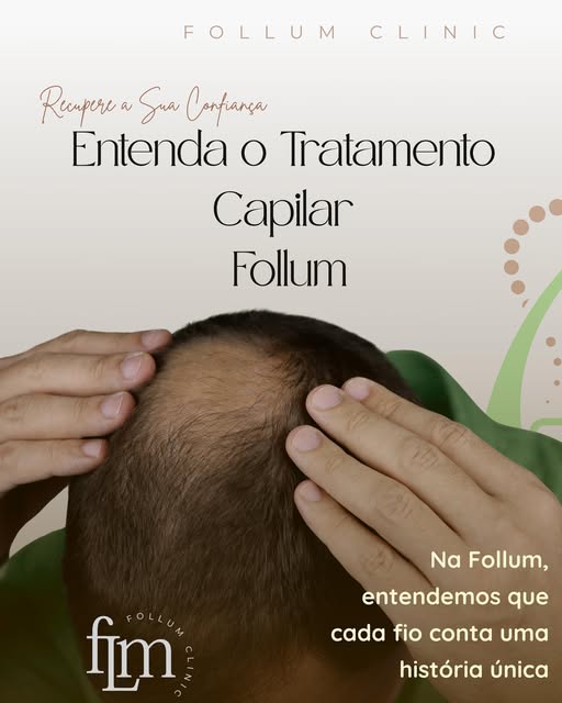 🌿 Entenda o Tratamento Capilar Follum e Recupere Sua Autoconfiança! 🌿

Na Follum, cada fio conta u