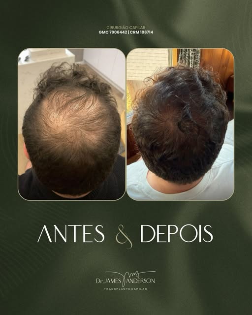 A primeira cirurgia mudou o terço frontal. A segunda etapa completou o projeto.

Este paciente já ha