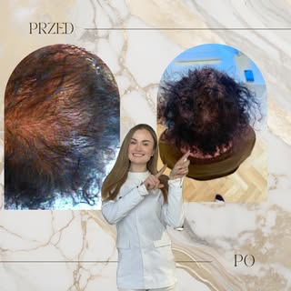 🫶💛 Efekt po 3 m-cach skrupulatnej suplementacji oraz indywidualnie dobranych produktów trychologic