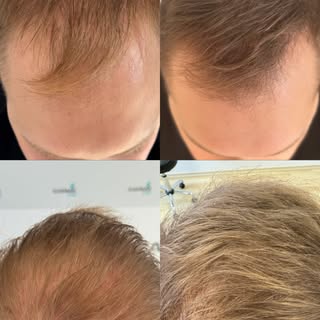 Interesse an einer PRP-Behandlung? ✨ 
Schreiben Sie uns einfach eine DM oder kontaktieren Sie uns di